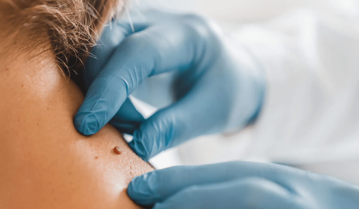 Is It Safe to Remove Skin Tags at Home? What You Should Know